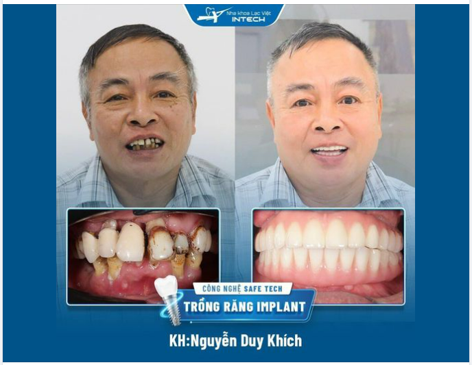 CUỘC SỐNG CỦA TÔI ĐÃ THAY ĐỔI TỪ KHI TRỒNG RĂNG IMPLANT