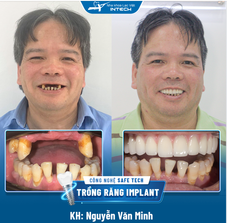 TRỒNG RĂNG IMPLANT ALL ON 6 SỬ DỤNG HÀM HYBRID PHỤC HÌNH VẬT LIỆU PUR CAO CẤP