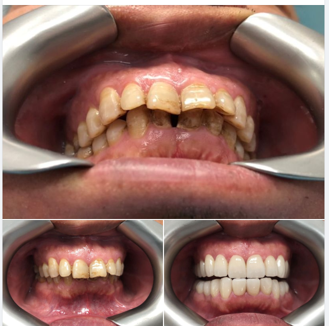 Hệ thống sứ YZ của hãng VITA - sản xuất tại Đức
