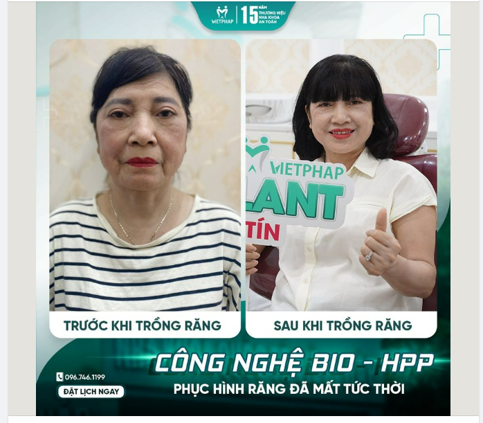 "Trồng răng Implant đã giúp cô lấy lại cuộc sống yên vui hạnh phúc bên gia đình, cô rất cảm ơn Nha khoa quốc tế Việt Pháp" - cô Trần Thanh Hà (46 tuổi) xúc động chia sẻ.