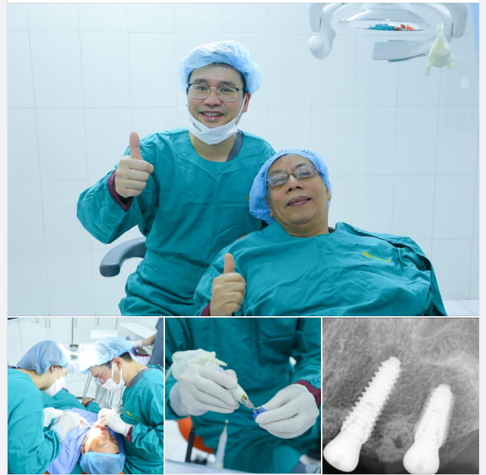 TẠI SAO KHI MẤT RĂNG- VIỆC TRỒNG LẠI LÀ RẤT CẦN THIẾT???