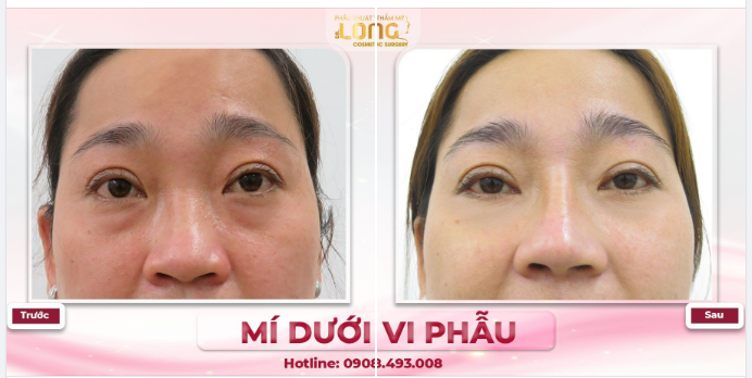 Bước vào độ tuổi trung niên, mắt sụp mí, da chùng, bọng mỡ khiến bạn quyết tâm đi tìm giải pháp cho đôi mắt.