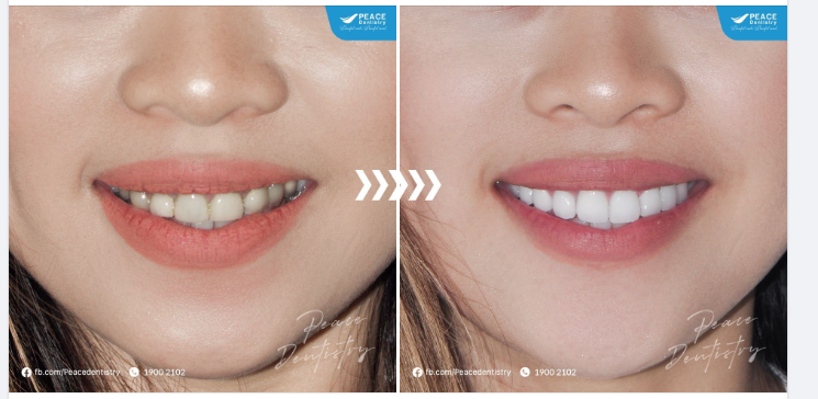 THAY RĂNG SỨ CŨ, BỌC LẠI RĂNG SỨ MỚI giúp "trẻ hoá" thay đổi ngoạn mục nụ cười