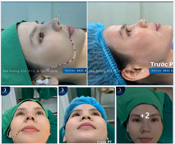 Hành trình thay đổi dáng mũi cho chị khách hàng đến từ Cà Mau