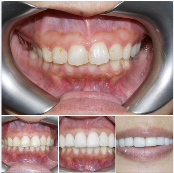 THẨM MỸ RĂNG CƯỜI HỞ NƯỚU, MIẾNG TRÁM CŨ TO