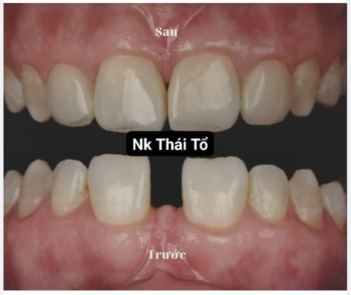 KHE THƯA RĂNG CỬA ẢNH HƯỞNG THẾ NÀO TỚI PHONG THỦY?