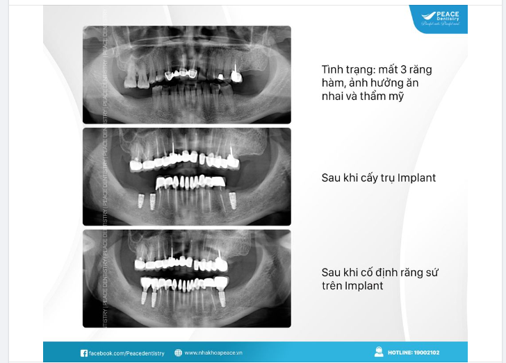 Ca lâm sàng cấy ghép 3 Implant hàm dưới tại  Peace Dentistry với kết quả rất tốt như thường lệ