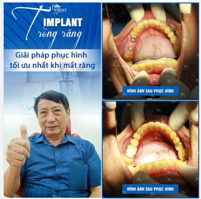 ĐỐI TƯỢNG NÀO NÊN TRỒNG RĂNG IMPLANT?