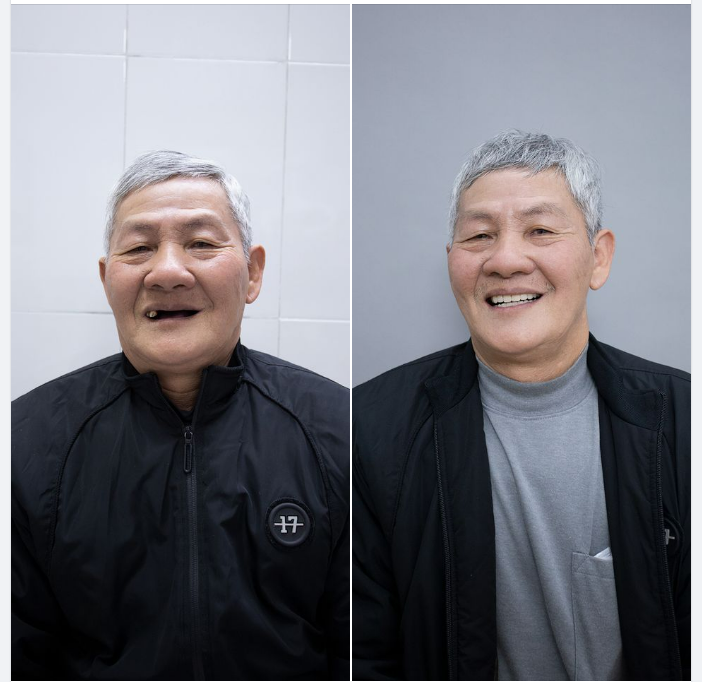 GIẢI PHÁP NÀO CHO NGƯỜI MẤT RĂNG TOÀN HÀM ???