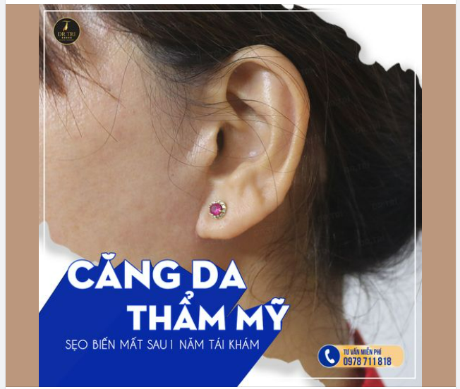 CĂNG DA V-LINE KHÔNG SẸO SAU 1 NĂM