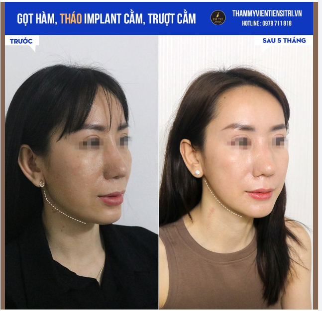GÓC NGHIÊNG KHÁC BIỆT  NHỜ: Gọt hàm, Tạo hình cằm, Nạo filler cằm