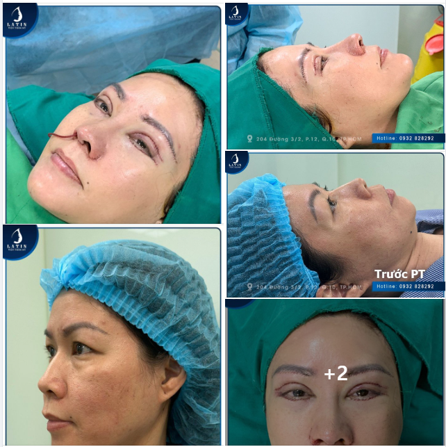 Chị gái U50 đi làm đẹp - Thay đổi toàn diện, nhan sắc trẻ trung