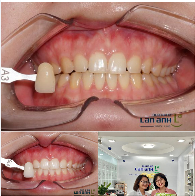 TẨY TRẮNG RĂNG TẠI PHÒNG CÓ HẠI CHO RĂNG KHÔNG ?!