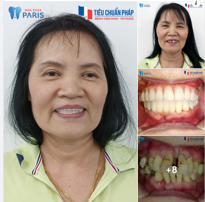 TRỒNG RĂNG CHUẨN BỆNH VIỆN PHÁP - KIỂM CHỨNG BỞI 25,000 KHÁCH HÀNG THÀNH CÔNG VỚI BÁC SĨ IMPLANT CÓ CHUYÊN MÔN CAO, HƠN 15 NĂM KINH NGHIỆM.