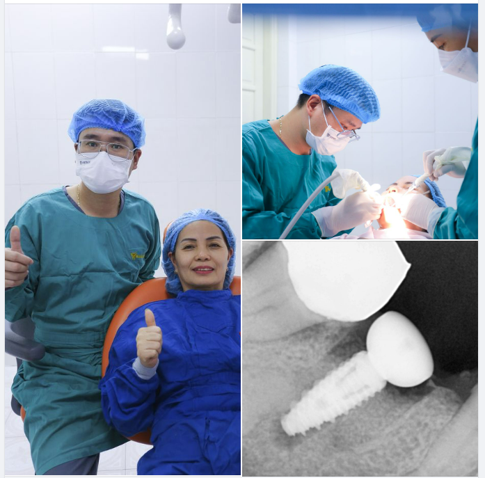 CÔ ĐI TỪ TUYÊN QUANG XUỐNG NHA KHOA QUỐC TẾ VIỆT MỸ MỚI LÀM ĐƯỢC BỘ RĂNG ƯNG Ý