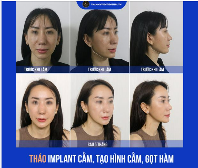 KHÔNG CẦN "XIN VÍA" TRẺ ĐẸP, CHỊ KHÁCH VẪN THÀNH CÔNG THAY ĐỔI DIỆN MẠO SAU 5 THÁNG KIÊN TRÌ !