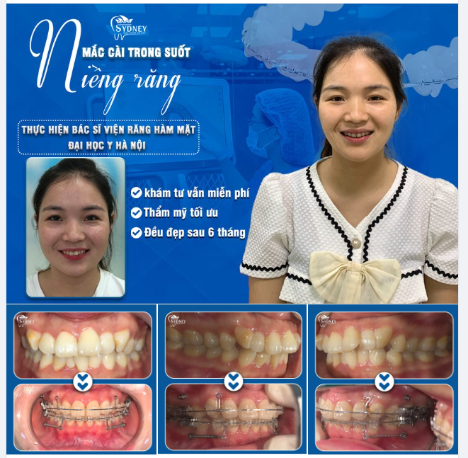 CÁCH CHĂM SÓC RĂNG MIỆNG KHI ĐEO MẮC CÀI