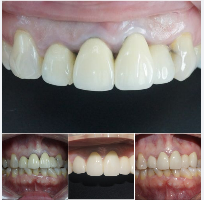 Răng sứ sườn kim loại dùng lâu năm gây đổi màu, đen dần phần viền nướu răng.