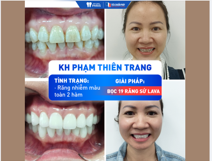 LÀM RĂNG SỨ LAVA TOÀN HÀM - TRẮNG ĐỀU TỰ NHIÊN