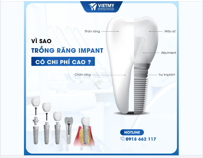 VÌ SAO TRỒNG RĂNG IMPLANT LẠI CÓ GIÁ CAO ?