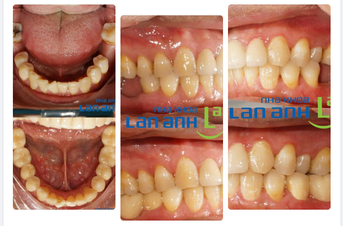 Hiện nay với tình trạng mất răng ngoài việc chọn cấy ghép Implant thì khách hàng có thể lựa chọn loại phục hình cầu răng sứ.