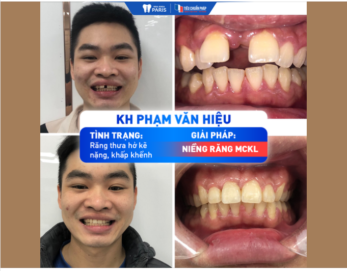 RĂNG THƯA HỞ KẼ NẶNG VÀ TÁC HẠI MÀ KHÔNG PHẢI AI CŨNG BIẾT ?!