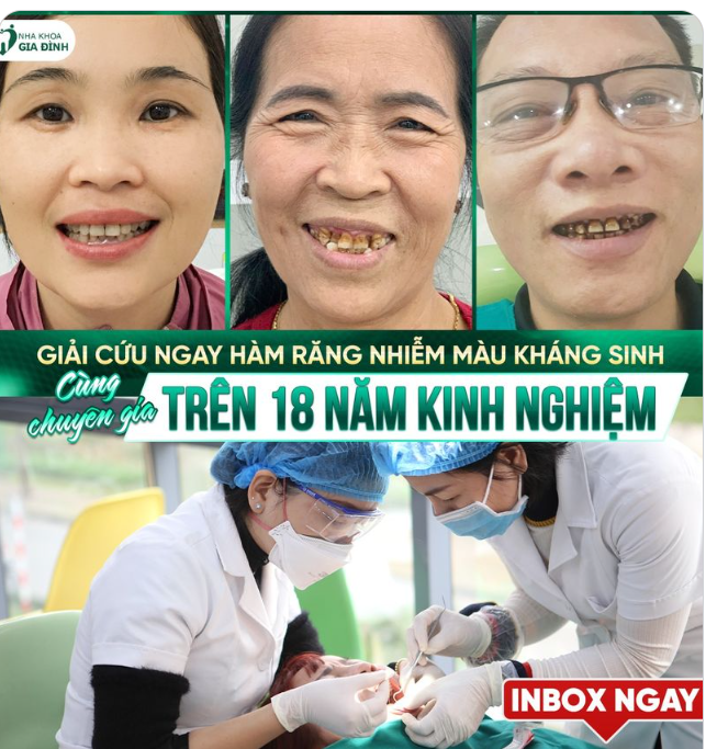 "TẨY CHAY" HÀM RĂNG NHIỄM MÀU KHÁNG SINH TRƯỚC KHI QUÁ MUỘN