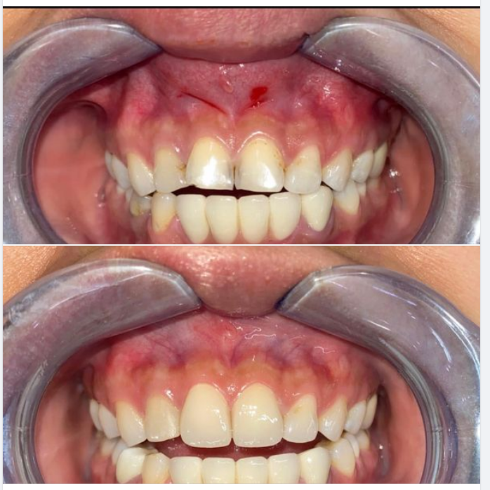 PHỤC HÌNH VENEER SỨ.
