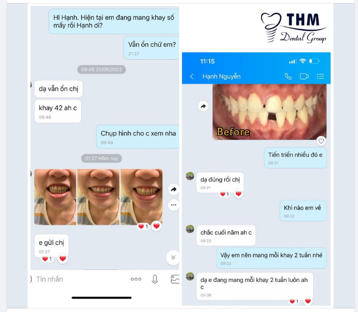 Vẫn định kỳ theo dõi và trao đổi với các KH du học nước ngoài đang niềng răng bằng khay Invisalign tại Dr Nguyen Phuong Thao