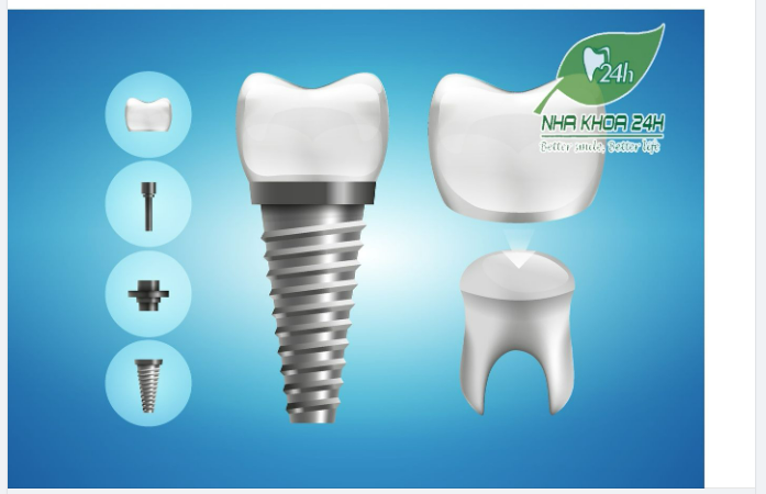 GIẢI ĐÁP NHỮNG CÂU HỎI THƯỜNG GẶP KHI CẤY GHÉP RĂNG IMPLANT TRONG MẤT RĂNG