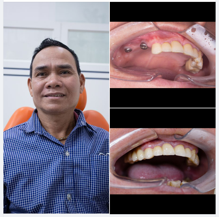 TRẺ RA 10 TUỔI NHỜ TRỒNG RĂNG IMPLANT
