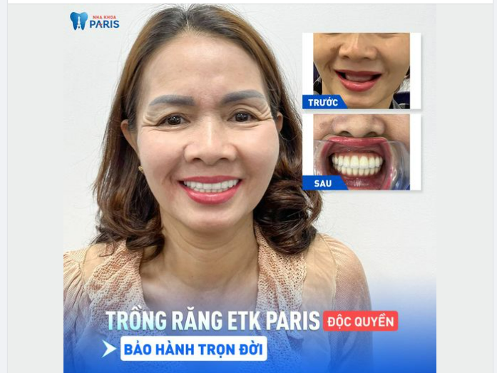 GÓI TRỒNG RĂNG TRỤ ETK PARIS ĐỘC QUYỀN