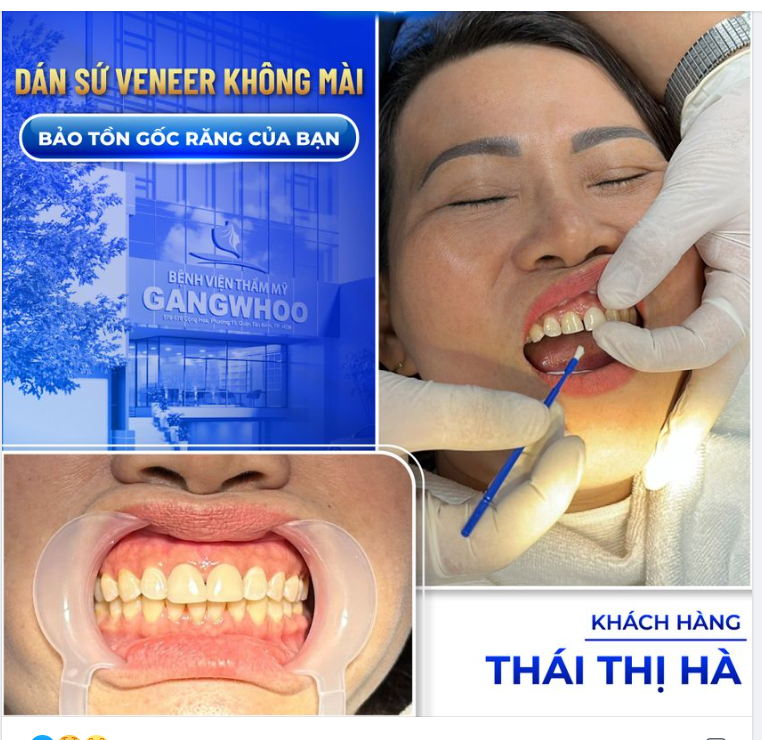 Dán sứ là một trong những phương pháp phục hình dáng răng phổ biến và được khách hàng của BVTM Gangwhoo ưa chuộng