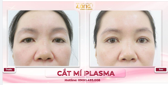 Khách hàng vừa mới hoàn thành ca cắt mí Plasma tại trung tâm Bác Long