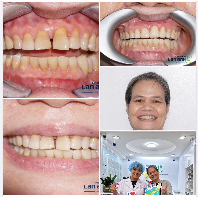 CÂU CHUYỆN KHÁCH HÀNG ĐI NHỔ RĂNG VÀ NIỀM TIN DÀNH CHO NHA KHOA LAN ANH.