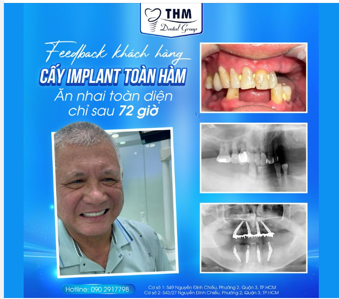 Feedback khách hàng CẤY GHÉP IMPLANT TOÀN HÀM - KHÔI PHỤC RĂNG CHỈ SAU 72 GIỜ