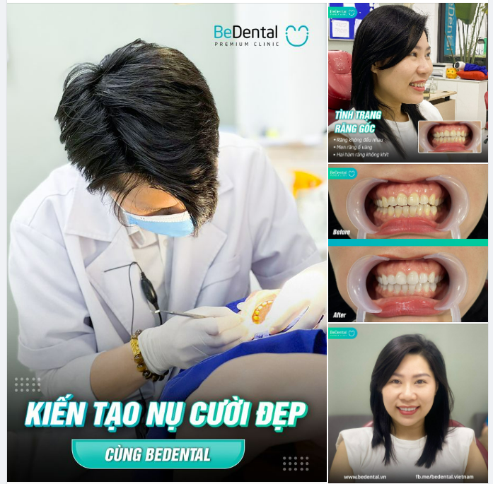 TẨY TRẮNG RĂNG TẠI BEDENTAL, ĐẸP MÊ MẨN CỠ NÀO?