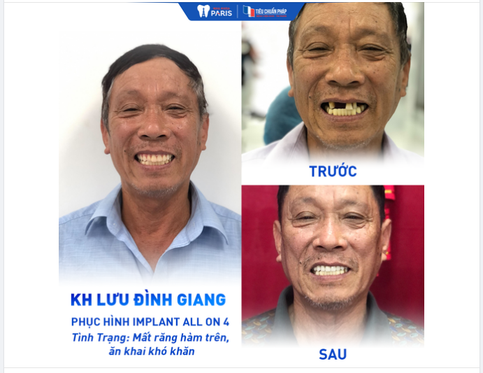 TRỒNG RĂNG IMPLANT CÀNG SỚM CÀNG TỐT - BỮA CƠM TRÒN VẸN, SỨC KHỎE ĐƯỢC CẢI THIỆN