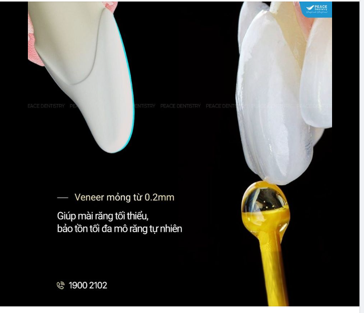 MẶT DÁN SỨ VENEER - PEACE DENTISTRY: XÂM LẤN TỐI THIỂU (English caption below)