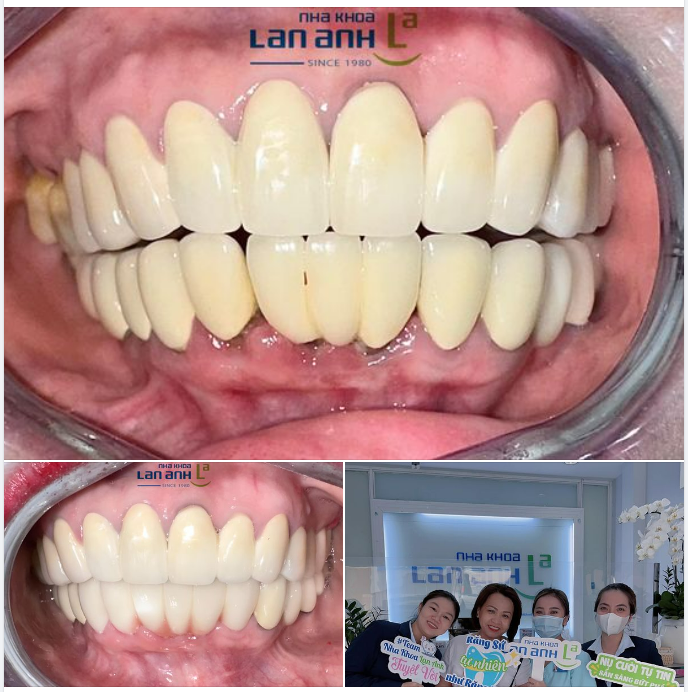 THAY RĂNG SỨ KIM LOẠI BẰNG RĂNG TOÀN SỨ.