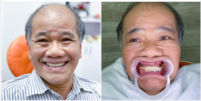 “Trồng răng xong thấy cuộc sống phấn khởi hẳn, ăn uống cũng ngon hơn…”