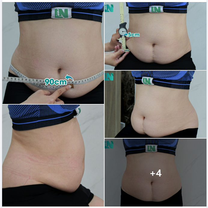 HÚT MỠ TẠO DÁNG THẨM MỸ BỤNG: LẤY LẠI DÁNG VÓC CHO CHỊ KH 7X ĐẾN TỪ ĐỒNG NAI, MỠ THỪA GẦN 20 NĂM. TRỰC TIẾP 15H00 HÔM NAY.