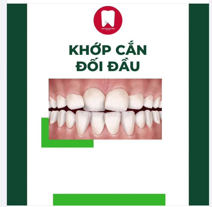 NIỀNG RĂNG - GIẢI PHÁP KHẮC PHỤC DỨT ĐIỂM TÌNH TRẠNG KHỚP CẮN ĐỐI ĐẦU