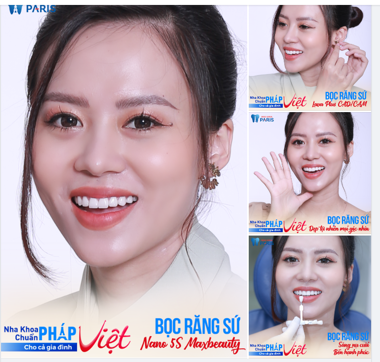 Thẩm mỹ 18R sứ Lava Plus được chế tác bằng công nghệ CAD/CAM, tinh xảo tới từng góc cạnh giúp tôn vinh đường nét sắc xảo và hài hòa cho khuôn mặt của Hà Trang.