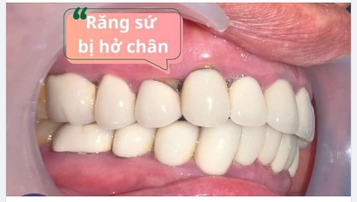 CẦN LÀM GÌ KHI BỌC RĂNG SỨ BỊ HỞ? 6 DẤU HIỆU BẠN CẦN BIẾT?