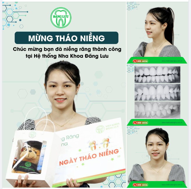 Mừng ngày tháo niềng Tạm biệt hành trình niềng răng hơn 2 năm