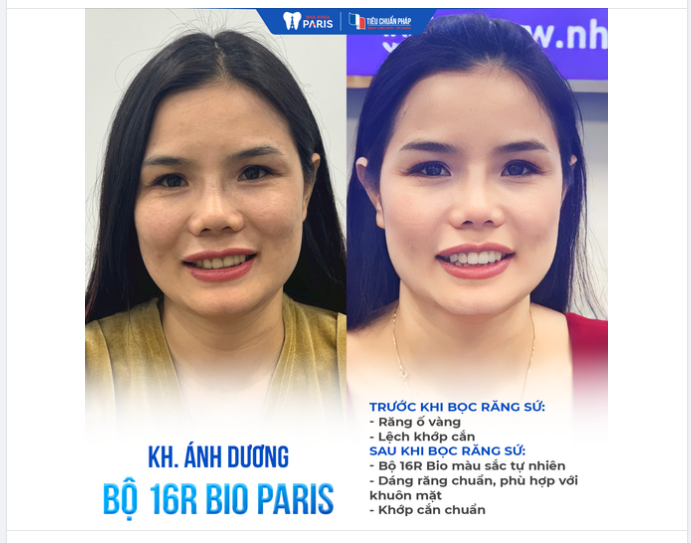 TẠI SAO KHÁCH HÀNG TẠI PARIS LẠI ƯA CHUỘNG DÒNG RĂNG SỨ BIO PARIS?