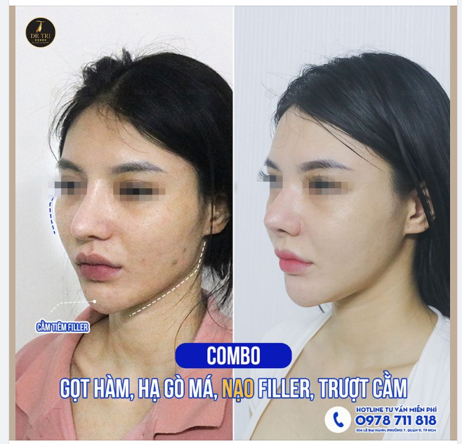 COMBO TRẺ ĐẸP BẤT DIỆT - COMBO TẠO HÌNH ĐƯỜNG VIỀN MẶT