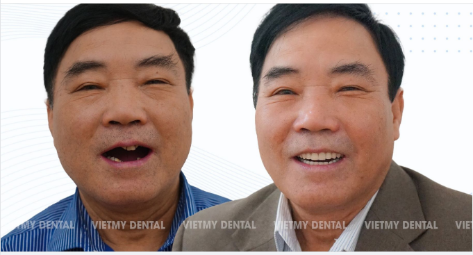 Mất răng toàn hàm là tình trạng toàn bộ răng trên 1 hoặc cả 2 cung hàm đều bị mất đi do một số nguyên nhân khác nhau.