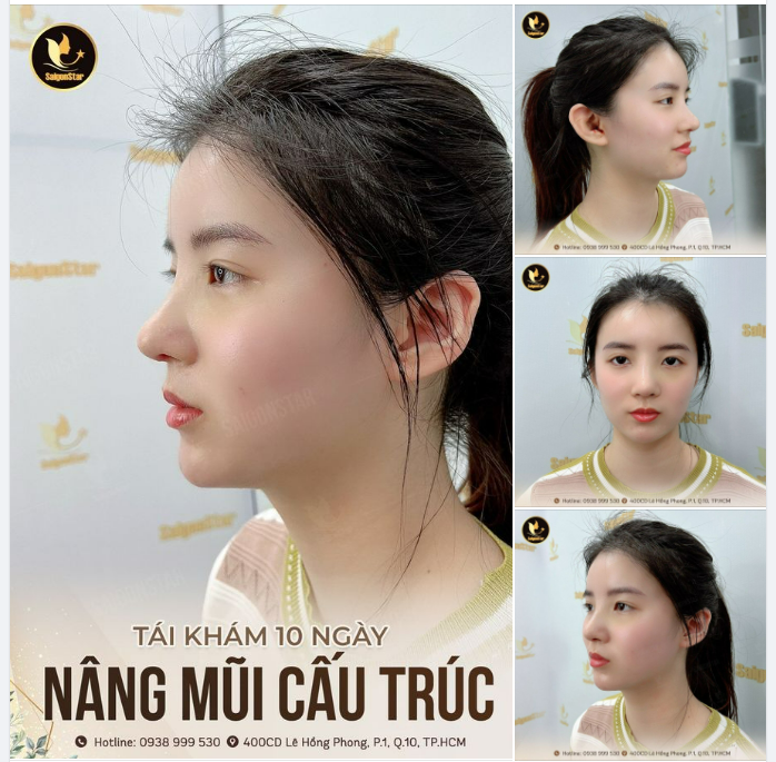 TÁI KHÁM 10 NGÀY NÂNG MŨI CẤU TRÚC